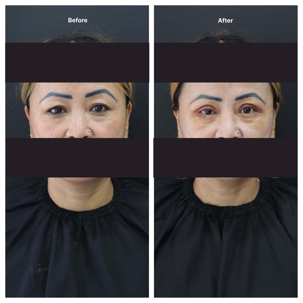 Eyelid Surgery KOQ10